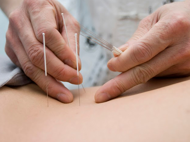 well4ever_clinic_putney_treatments_acupuncture